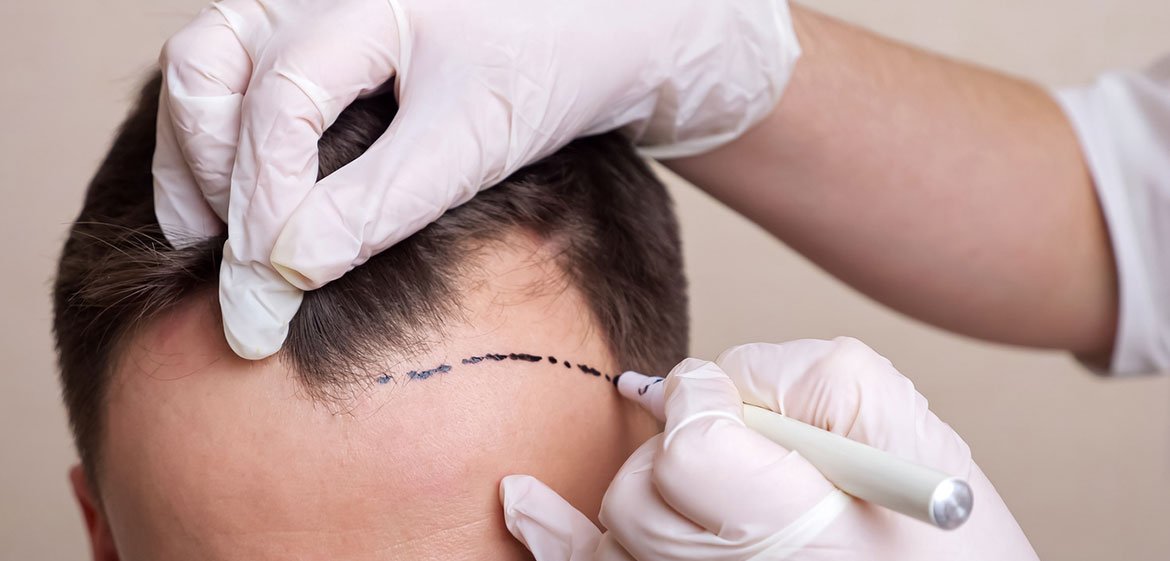 Arzt zeichnet auf der Stirn des Mannes mit Haarausfall (Geheimratsecken) den Bereich für eine Haartransplantation mit einem Stift an